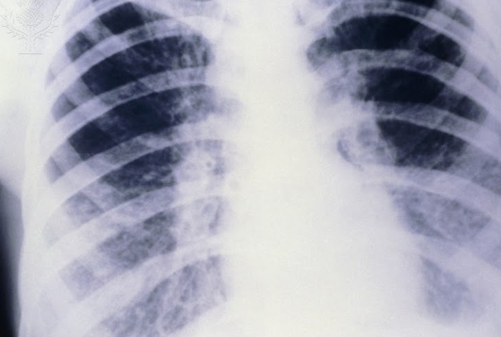 This+is+an+x-ray+of+the+lungs+of+someone+with+cystic+fibrosis.+It+is+an+inherited+condition+that+has+affected+an+estimated+30%2C000+adults+and+children+in+the+US.+%E2%80%9CFifty+percent+of+%5Btransplant%5D+recipients+end+up+passing+away+within+five+years%2C%E2%80%9D+Mr.+Bauer%2C+English+teacher+and+husband+of+a+cystic+fibrosis+survivor%2C+said.